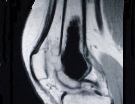 Figura 6: Ressonância magnética, corte sagital T1, ressaltando extravasamento da lesão na face anterior do fêmur, sob a patela.