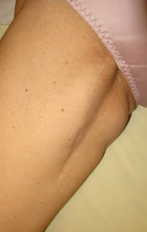 Figura 16: Aspecto da cicatrização da ferida operatória, após a cirurgia e o tratamento radioterápico adjuvante.