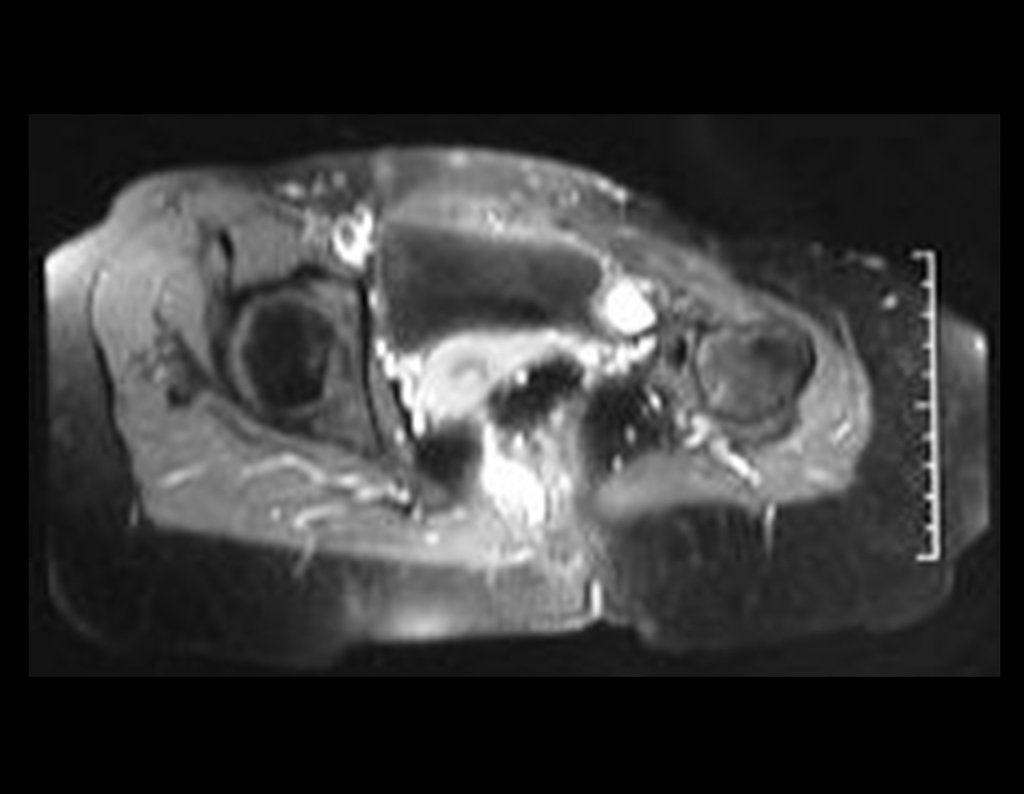 Figura 64: RM axial T1 Spir, com contraste, após dois anos da cirurgia.