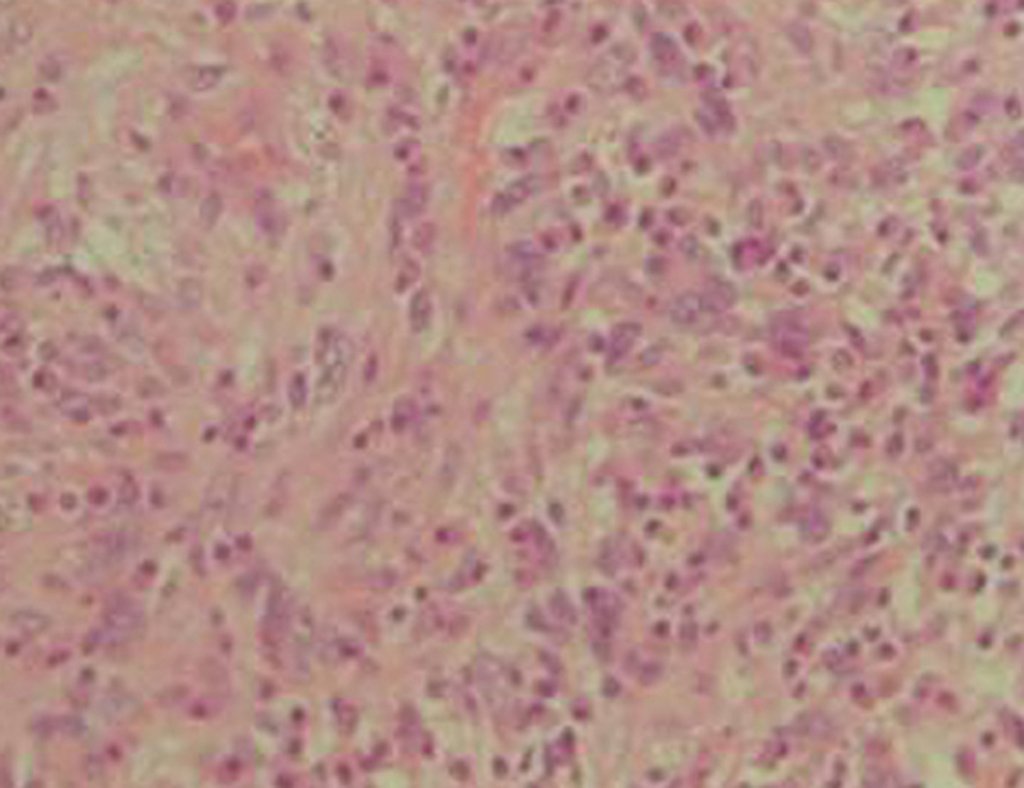 Figura 13: Anaplasia, caracterizando sarcoma indiferenciado de alto grau.