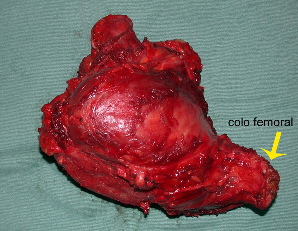 Figura 35: Visão da face ventral da hemipelve ressecada, juntamente com o colo femoral e o complexo capsulo-ligamentar do quadril, evidenciando o grande volume tumoral.