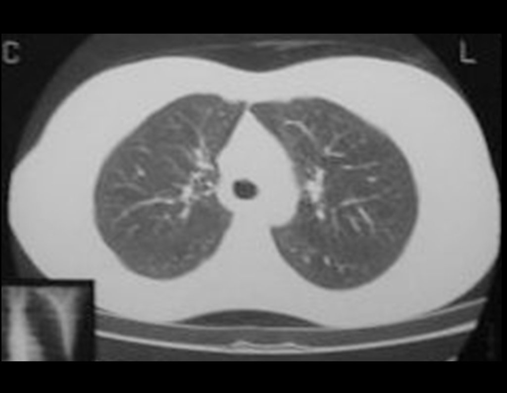 Figura 68: RM do tórax normal, após três anos da cirurgia.
