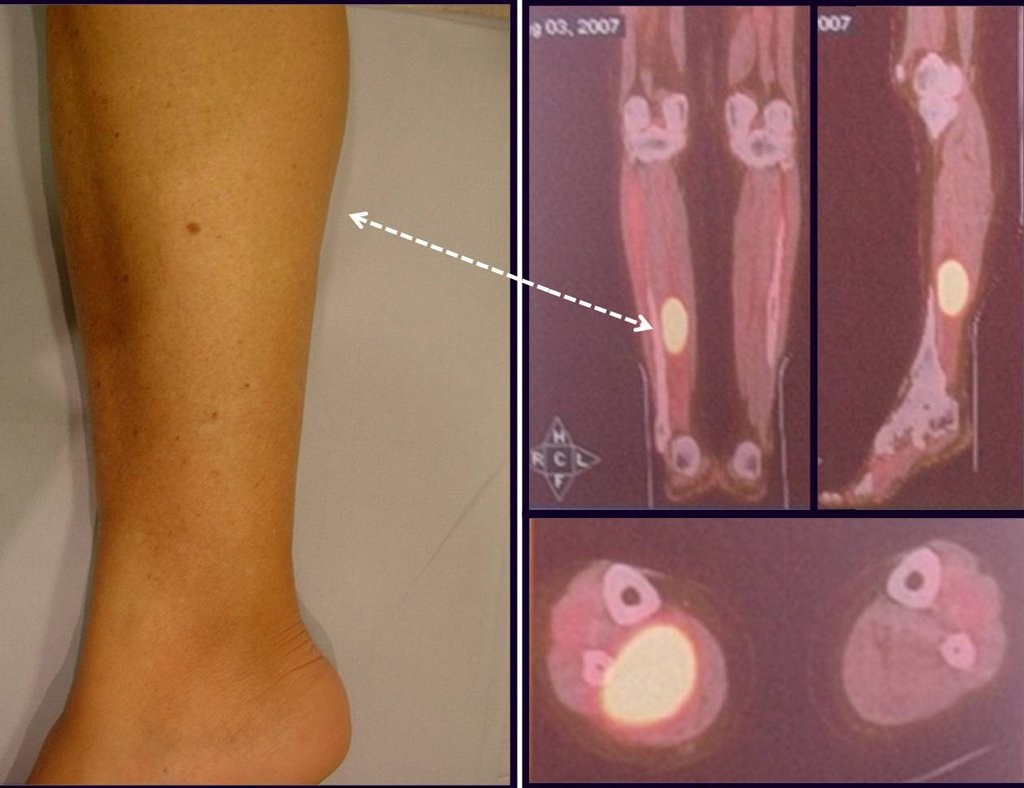 Figura 36: Uma visualização em perfil da panturrilha direita.Figura 37: Lesão metastática na panturilha.