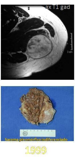 Figura 44: Ressonância magnética em T1 do tumor. Figura 45: Peça ressecada em 1999. Figura 46: Ressonância magnética sagital em T1.