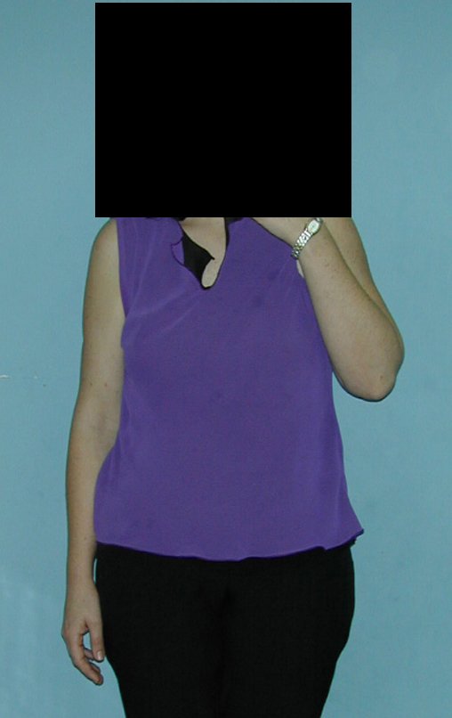 Figura 30: Paciente em 2001, após 14 anos. bem.