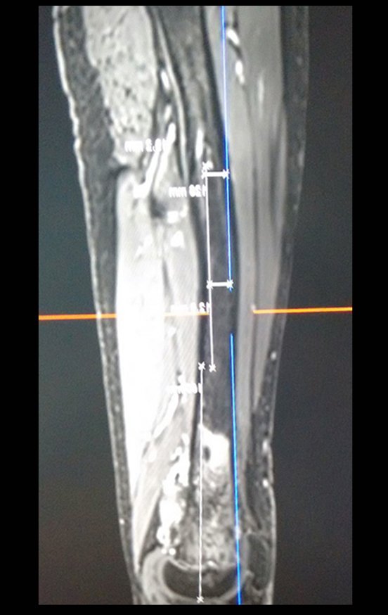 Figura 27: Rm sagital T1, com supressão de gordura, pós quimioterapia, avaliando a extensão da lesão. Observamos que o paciente apresenta acentuação do antecurvatum do fêmur.