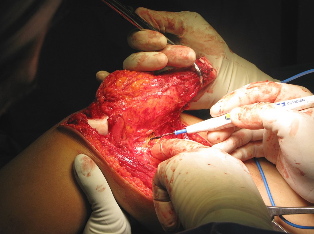 Figura 45: Após a osteotomia prosseguimos liberando a cápsula posterior, completando a ressecção do tumor,