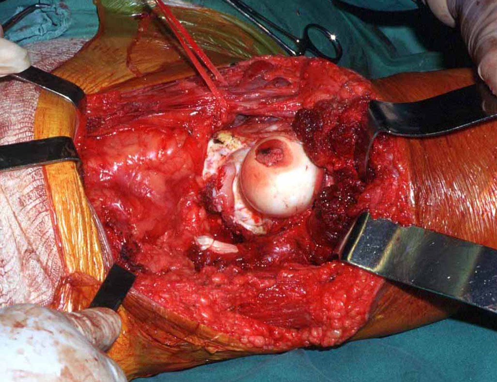 Figura 24: Leito operatório, após a ressecção do anel obturatório. Revisão cuidadosa da hemostasia. Em detalhe a cabeça do fêmur, com o ligamento redondo seccionado.
