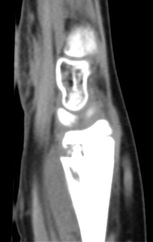 Figura 156: Tomografia de 31/Maio/2016, sagital, densidade para tecidos moles.