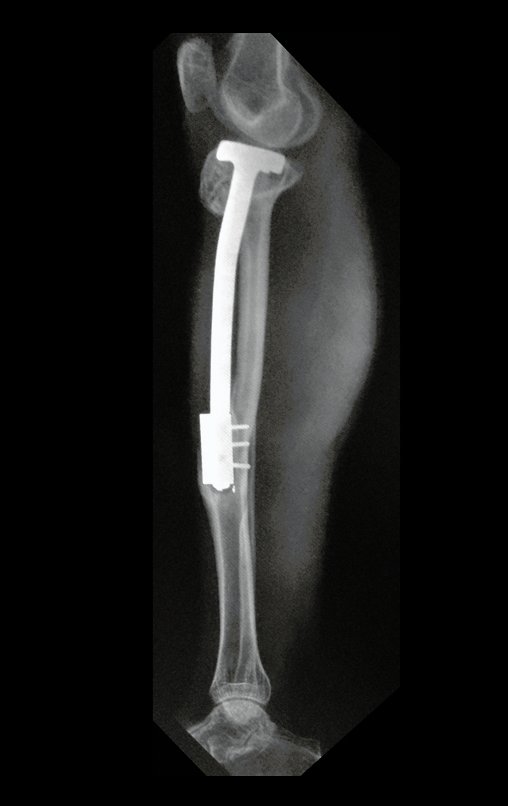 Figura 160: Radiografia perfil, com excelente hipertrofia da fíbula, já tibializada, em 15/11/2015, após 16 anos da cirurgia.