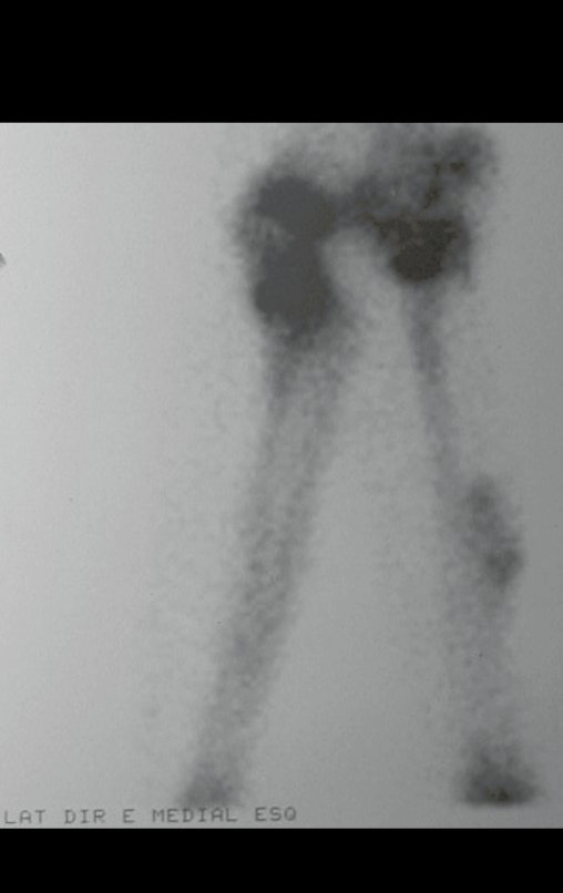 Figura 86: Cintilografia localizada, lateral direita, mostra a vitalidade da fíbula transplantada e a vitalidade da sua placa de crescimento.