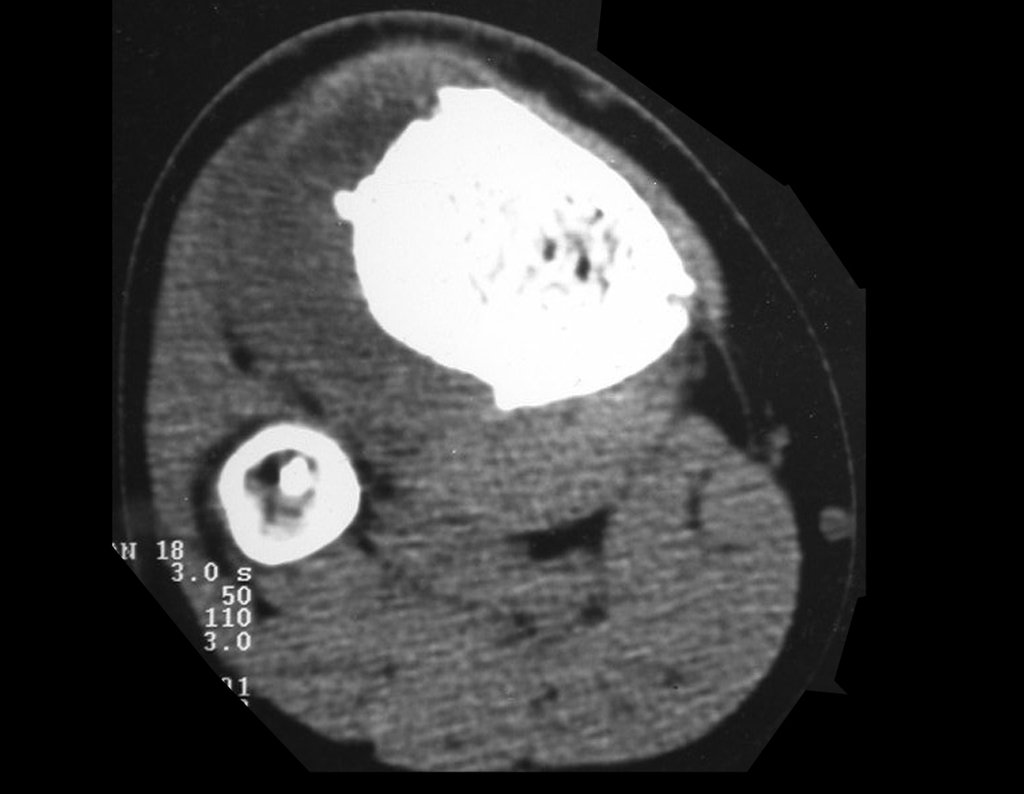 Figura 3: Tomografia de 29/04/1999, lesão condensante na metáfise proximal da tíbia, formadora de osso, com tumor extracortical na região anterior, lateral e posterior, densidade para osso.