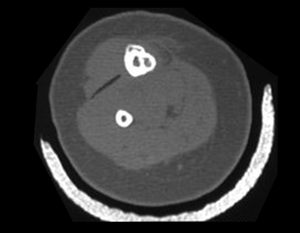 Figura 9: Tomografia com densidade para tecidos moles revelando a extensão da lesão, no plano axial.