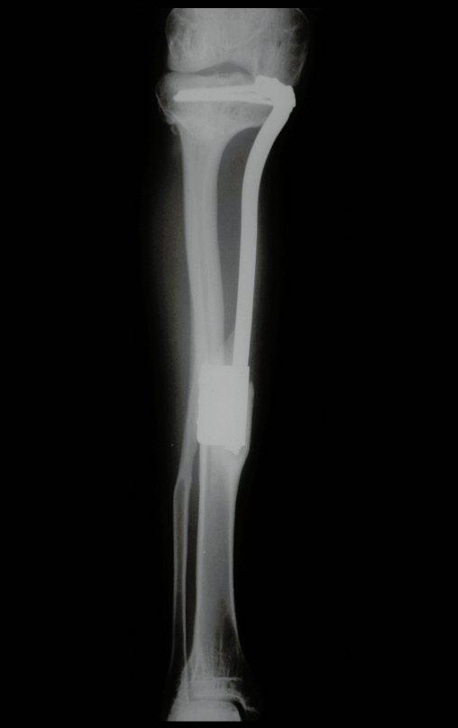 Figura 123: Radiografia de 21/10/2002, após três anos, com boa hipertrofia da fíbula e bom alinhamento do membro operado.