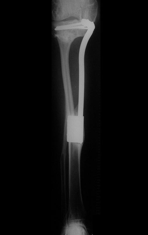 Figura 94: A fíbula continua aumentando a sua espessura, "tibializando-se". Radiografia de 08/05/2001.