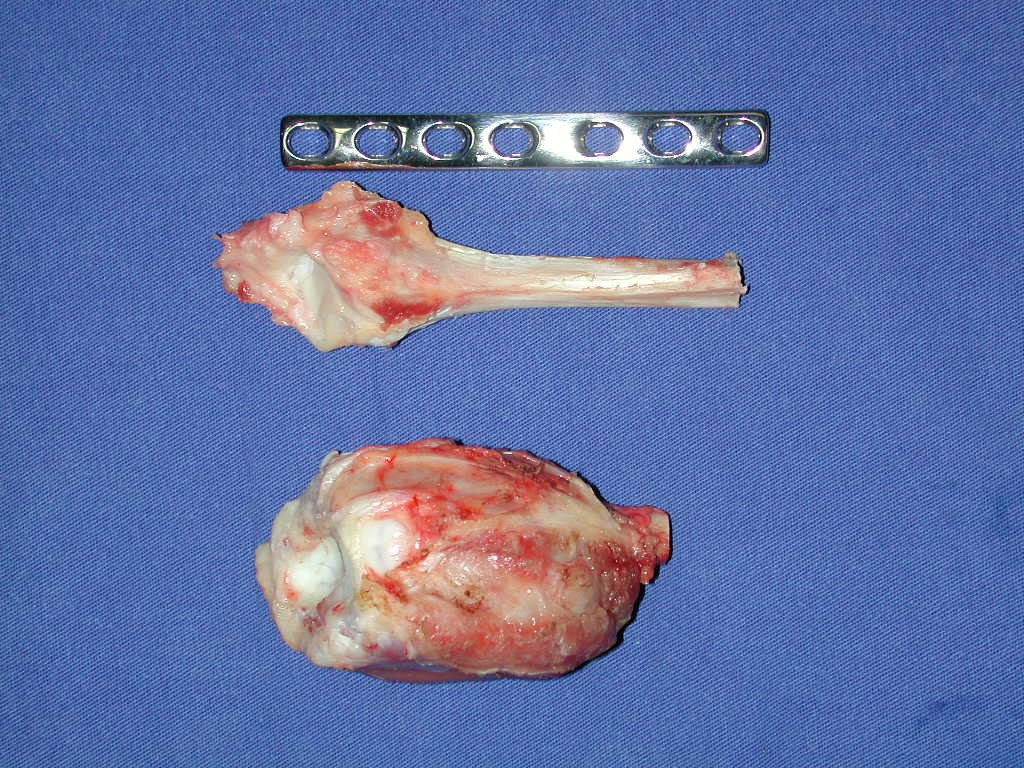 Figura 75: Enxerto obtido para substituir o segmento ressecado. Observe o tecido capsular preservado no enxerto, em toda a sua circunferência. Uma placa DCP com sete orifícios será utilizada para a fixação do enxerto ao rádio remanescente.