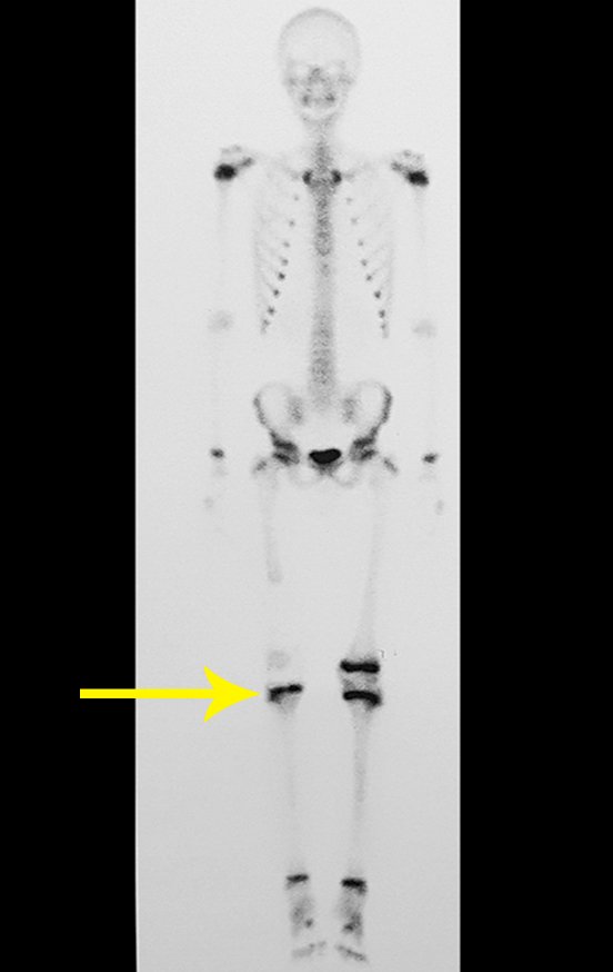 Figura 163: Em destaque, a cintilografia mostra que a fise da tíbia do lado operado encontra-se viável, seta amarela.