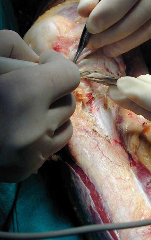 Figura 31: Secção do ligamento colateral medial e marcação da osteotomia proximal da tíbia do lado medial, curvilínea para preservar a epífise.