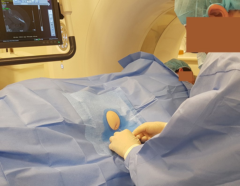 Figura 99: Biópsia sob sedação e controle de tomografia.