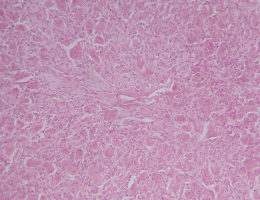 Figura 19: Histologia revelando neoplasia benigna, com inúmeras células gigantes em meio a estroma de células, cujos núcleos se assemelham aos núcleos das células gigantes. TGC