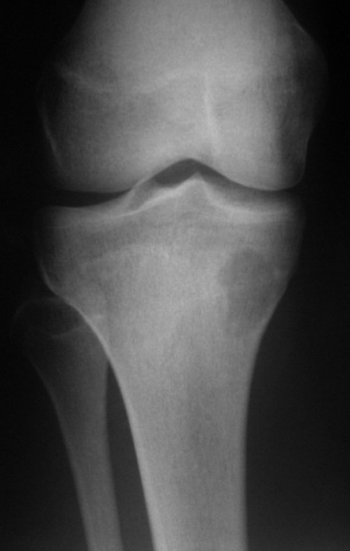 Figura 1. A: Radiografia inicial com lesão de rarefação óssea, na região metafisária medial proximal da tíbia direita.