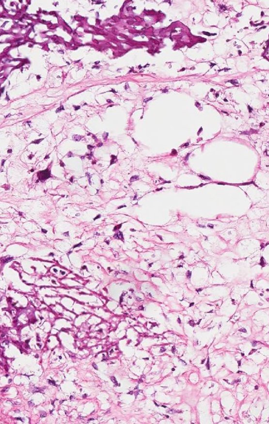 Figura 102: Áreas de necrose pós quimioterapia, 45% de necrose - Huvos I.