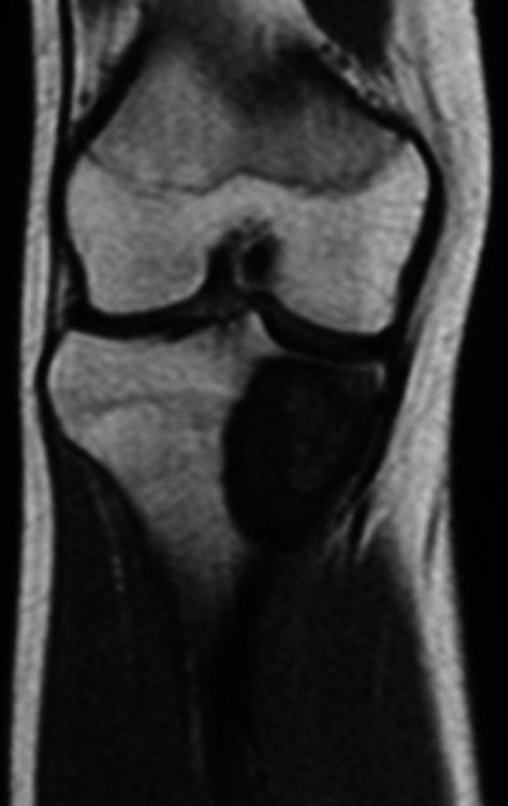 Figura 25. A: RM Cor T1, pós quimioterapia.