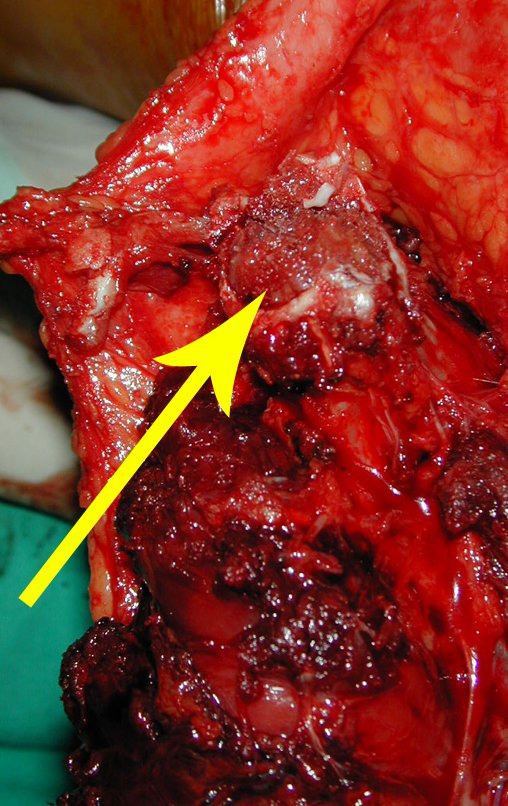 Figura 36: Remoção da cartilagem articular da epífise fibular proximal, expondo-se o osso epifisário - seta amarela, facilitando a consolidação com a epífise tibial.