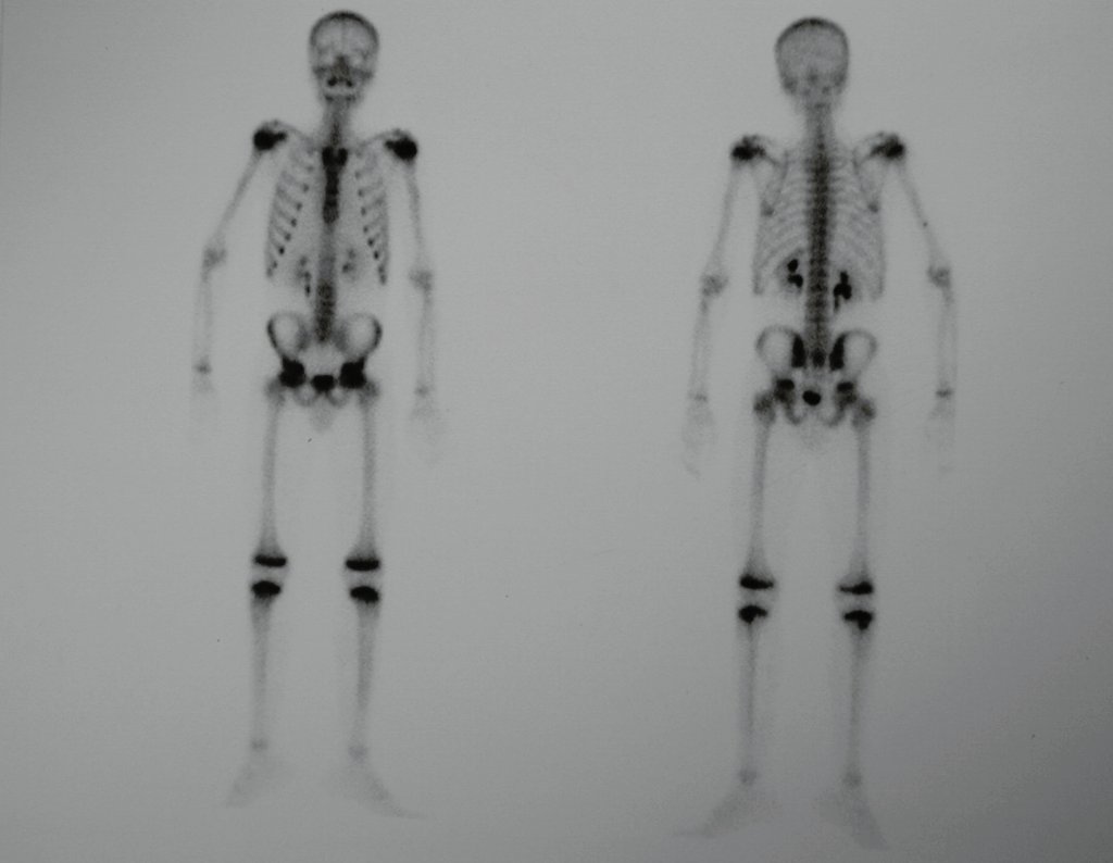 Figura 19: Cintilografia de outubro de 1999, pré-operatória.