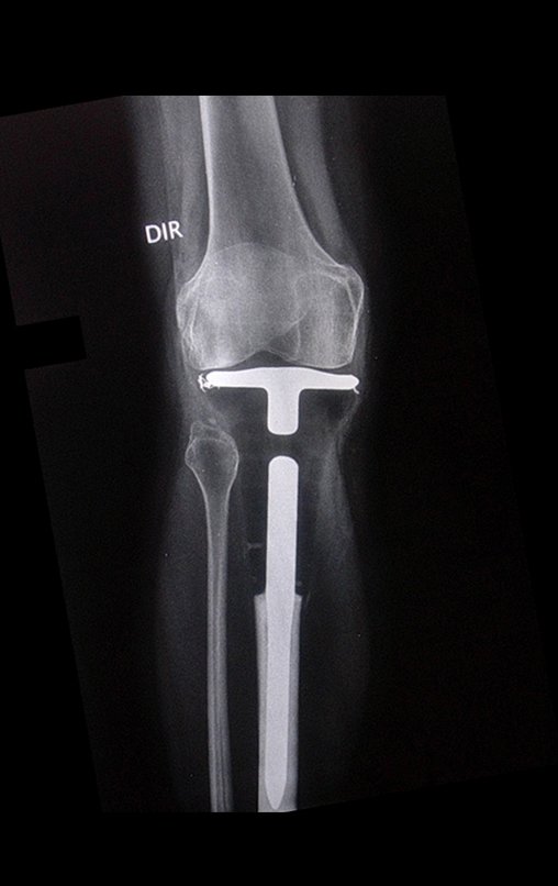 Figura 113: Radiografia, Frente. Prótese estável e alinhada, após dois anos da cirurgia.