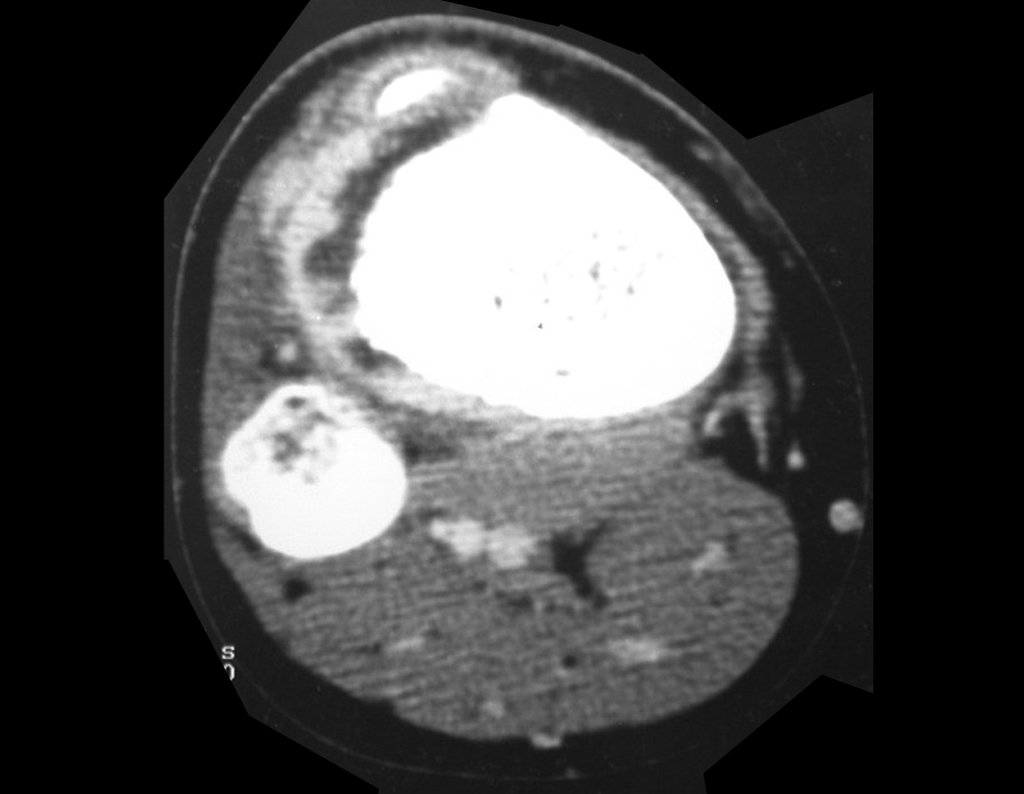Figura 4: Tomografia de 29/04/1999, lesão condensante na metáfise proximal da tíbia, formadora de osso, com tumor extracortical na região anterior, lateral e posterior, densidade para tecidos moles.