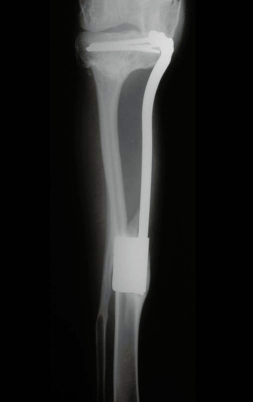 Figura 127: Radiografia de 31/12/2002, após três anos e dois meses, com boa hipertrofia da fíbula e bom alinhamento do membro operado.