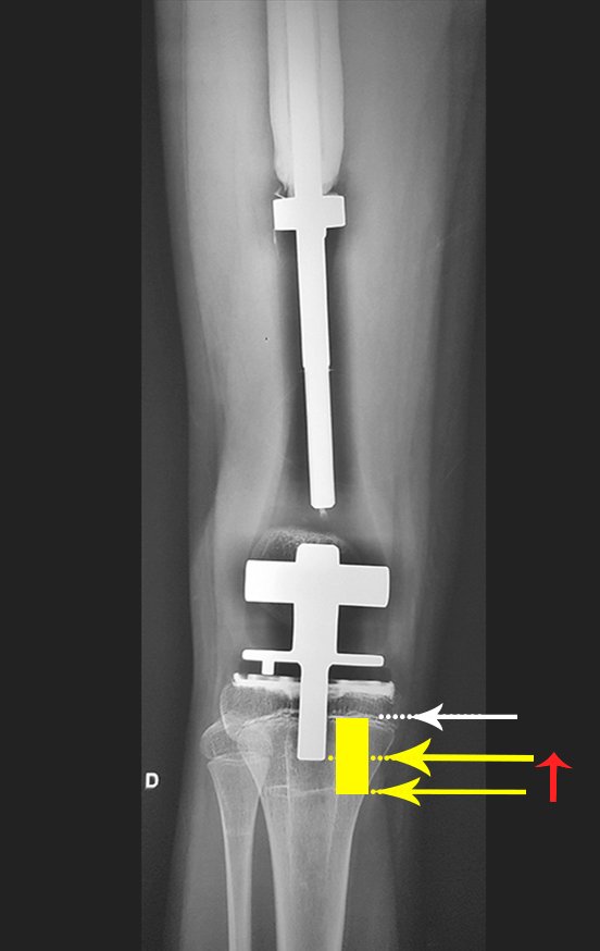 Figura 166: As sinalizações na radiografia mostram o crescimento da placa fisária da tíbia. Seta branca assinala a cartilagem de crescimento, seta vermelha o pico de crescimento.