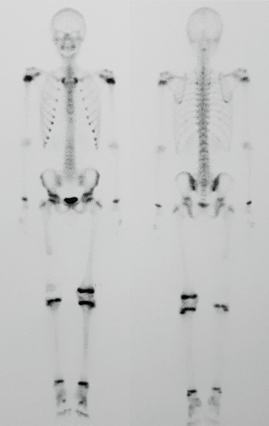 Figura 162: Cintilografia óssea revelando a viabilidade da linha epifisial da tíbia do lado operado, apesar da existência da haste tibial.