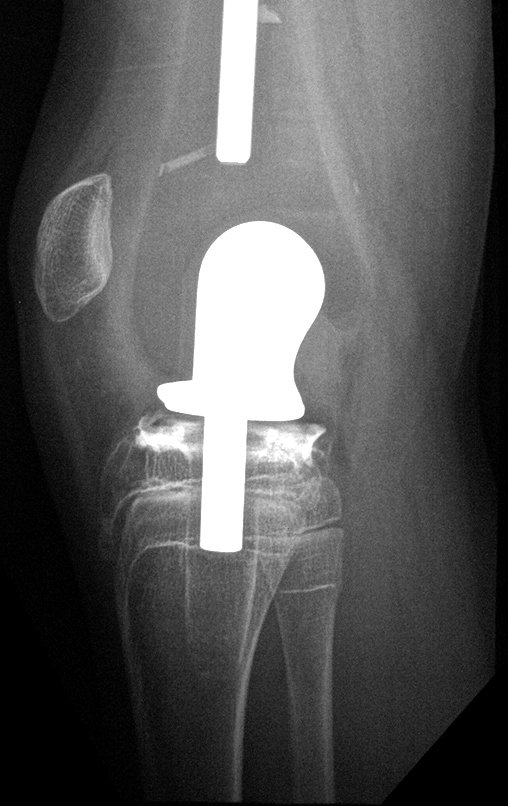 Figura 158: Radiografia de perfil, em maior aumento, de 10/10/2015, destacando o crescimento da cartilagem epifisial da região proximal da tíbia.
