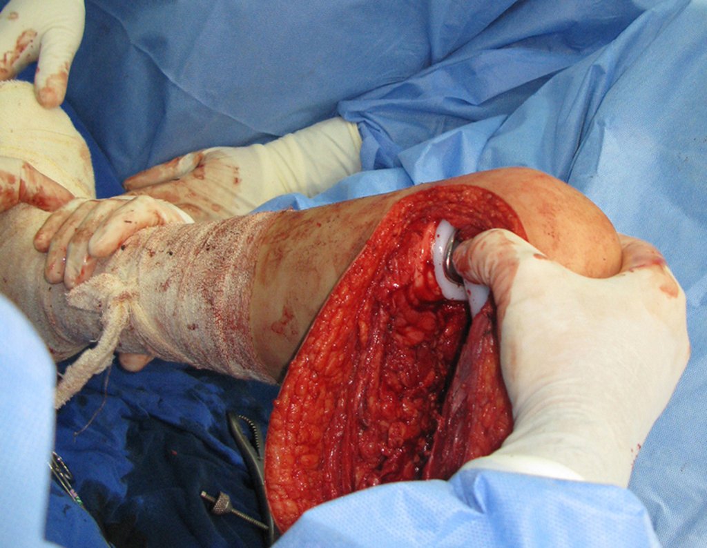 Figura 79: Colocação do componente femoral para teste de prova.