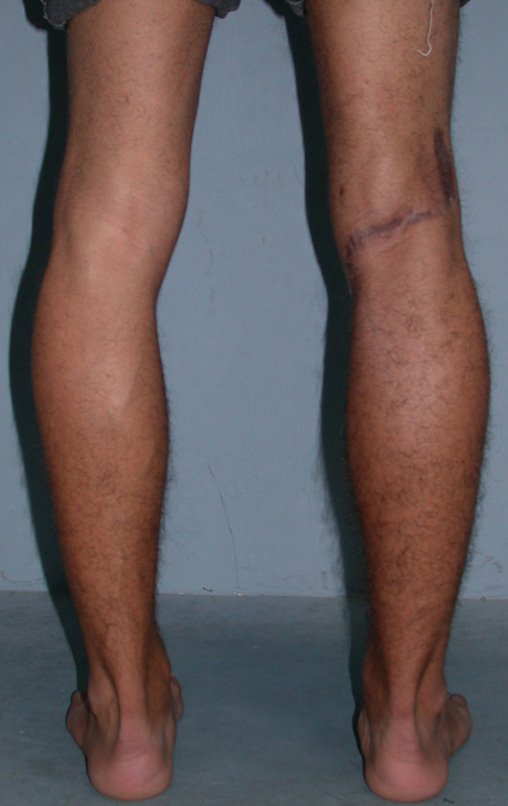 Figura 103: Paciente curado do condrossarcoma periférico, exofítico, que cresceu sobre um osteocondroma. Função normal do membro operado.