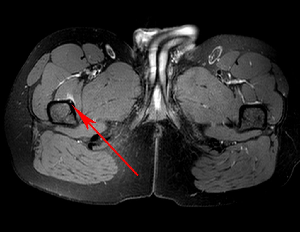 Figura 5: Ressonância axial T1 com contraste evidencia nidus na face anterior da cortical femoral, delimitada por halo de esclerose óssea e captação de contraste.