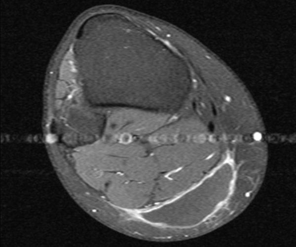 Figura 15: Ressonância magnética atual evidenciando imagem axial ponderada em T1 contrastada e com supressão de gordura. Vemos lesão de baixo sinal com realce periférico do contraste, bem delimitado e homogeneamente de baixo sinal no interior da lesão. A lesão esta dissecando o plano entre o tecido celular subcutâneo e a fascia muscular Figura 15: Ressonância magnética atual evidenciando imagem axial ponderada em T1 contrastada e com supressão de gordura. Vemos lesão de baixo sinal com realce periférico do contraste, bem delimitado e homogeneamente de baixo sinal no interior da lesão. A lesão esta dissecando o plano entre o tecido celular subcutâneo e a fascia muscular